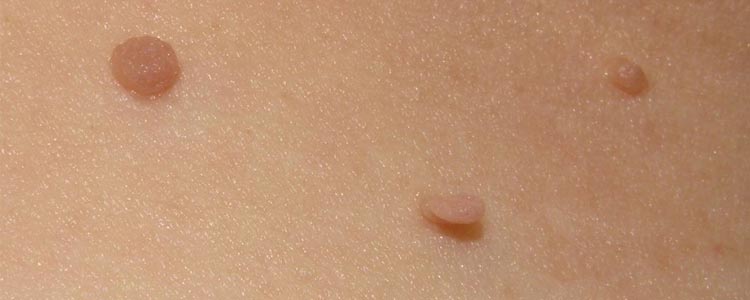 Ways to remove nasty skin tags