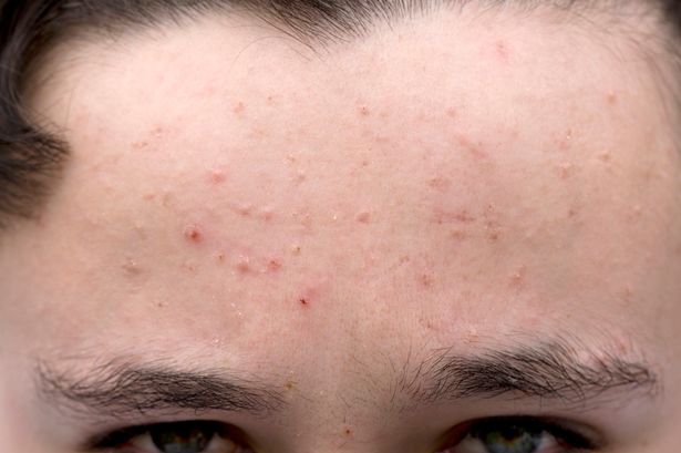Acne pimple