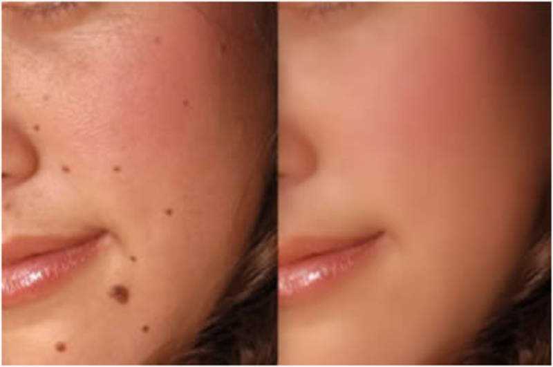 Remove Mole Naturally!