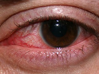 eye infection