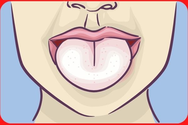 Pale tongue