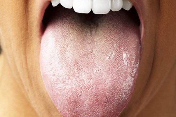 White coating on the tongue