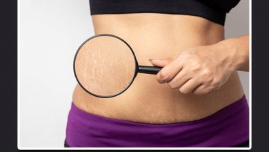 Get Rid Of Stretch Marks