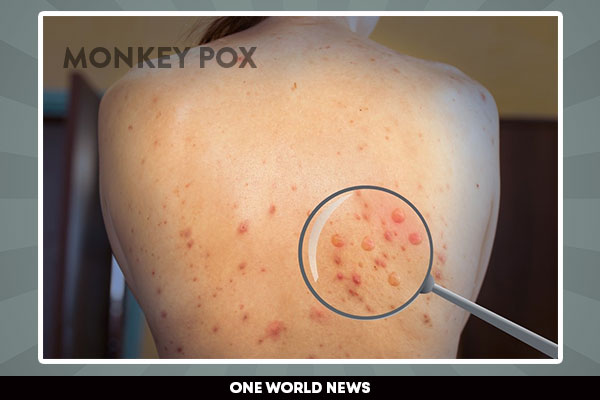 Monkeypox