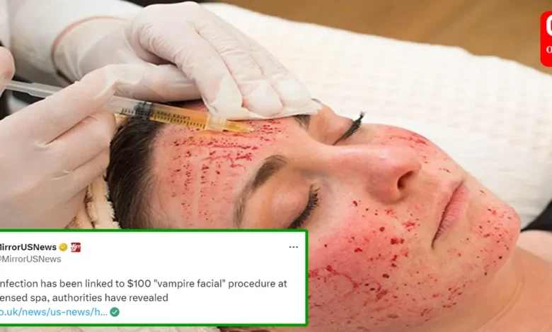 Vampire Facial HIV Infections in US Spa