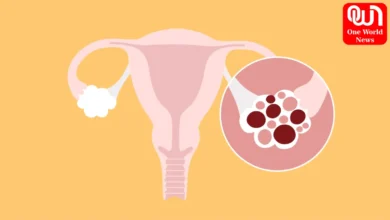 PCOS Intersex