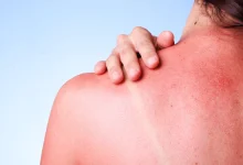 Sunburned Skin