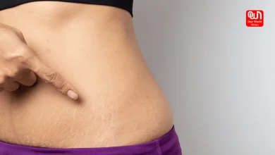 pregnancy stretch marks