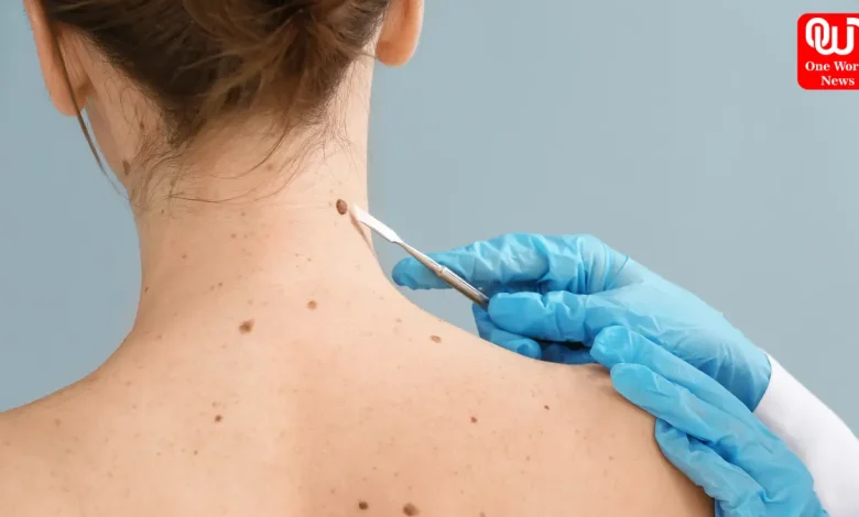Skin cancer