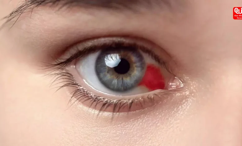 Marburg Virus Outbreak Deadly Bleeding Eye Disease