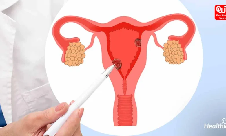 Cervical Cancer