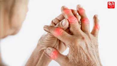 Rheumatoid Arthritis