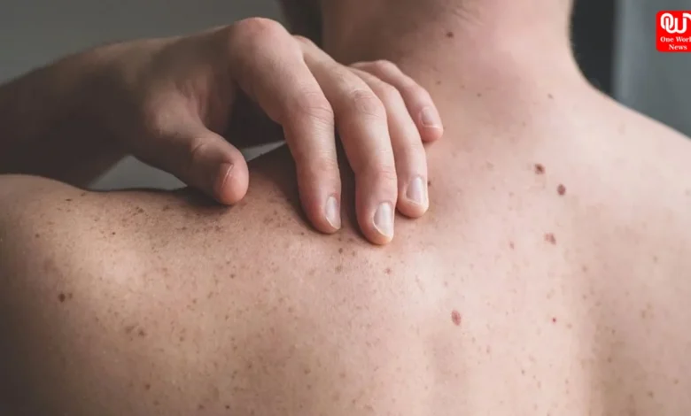 Psoriasis