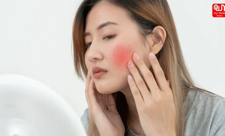 Skin Infections