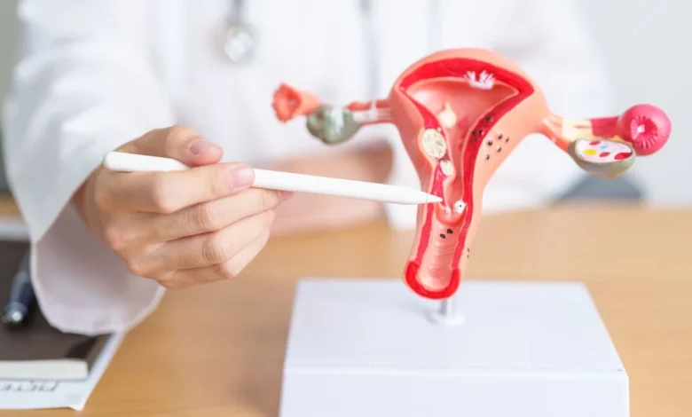 Endometriosis