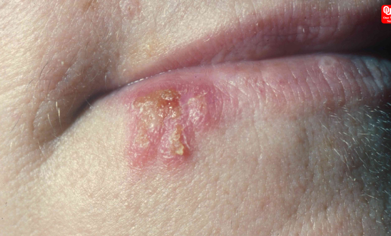 Sexually Transmitted Infections