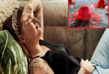 Stomach Cancer