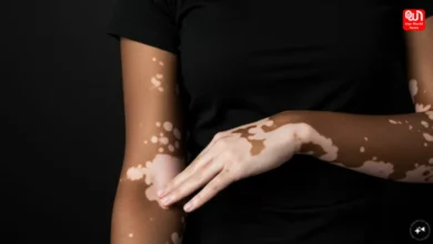 Vitiligo Patients