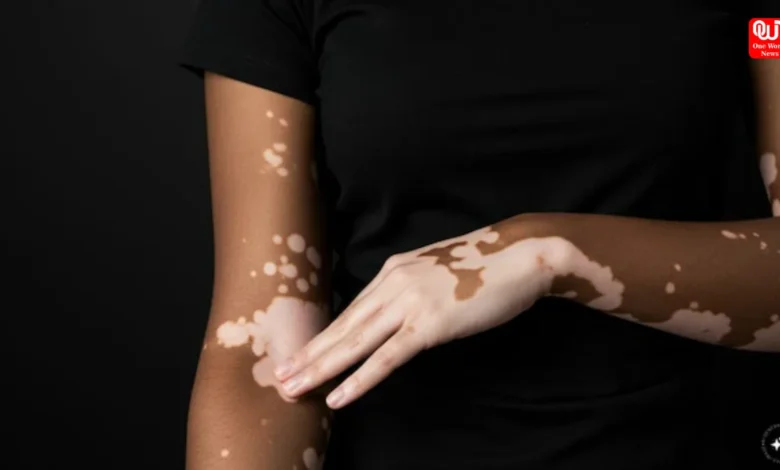 Vitiligo Patients