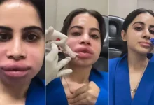 Dissolving Lip Fillers