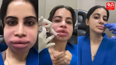 Dissolving Lip Fillers
