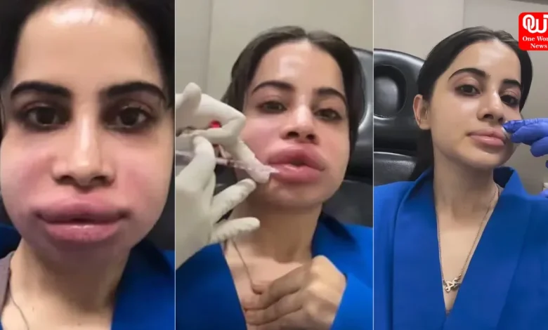 Dissolving Lip Fillers