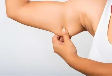 Arm Fat, Arm Excess