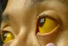 Jaundice