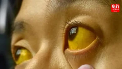 Jaundice