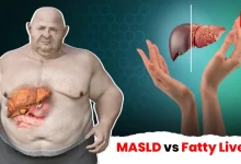 MASLD vs Fatty Liver