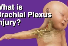 Brachial Plexus Birth Injuries