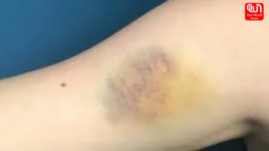 natural treatment for bruises