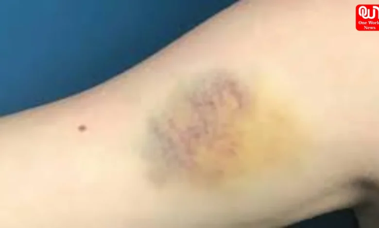 natural treatment for bruises