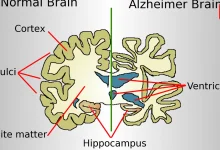 Alzheimer’s Disease