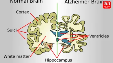 Alzheimer’s Disease