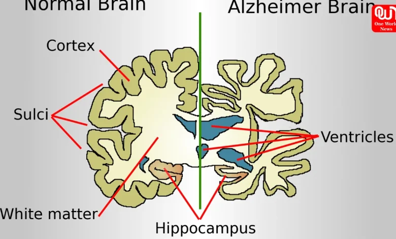 Alzheimer’s Disease