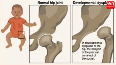 Developmental Dysplasia Hip