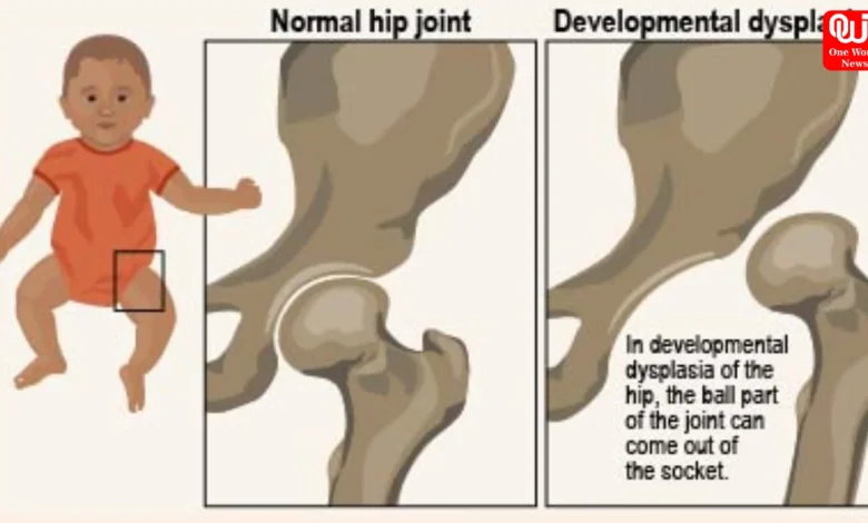 Developmental Dysplasia Hip