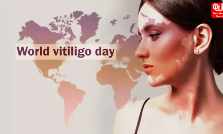 World Vitiligo Day