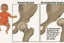 Developmental Dysplasia