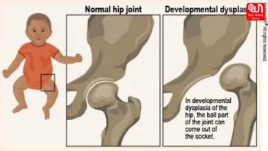 Developmental Dysplasia