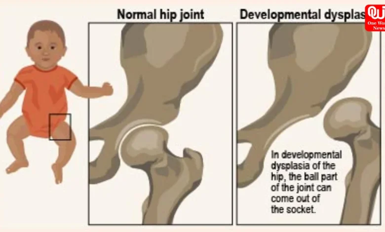 Developmental Dysplasia