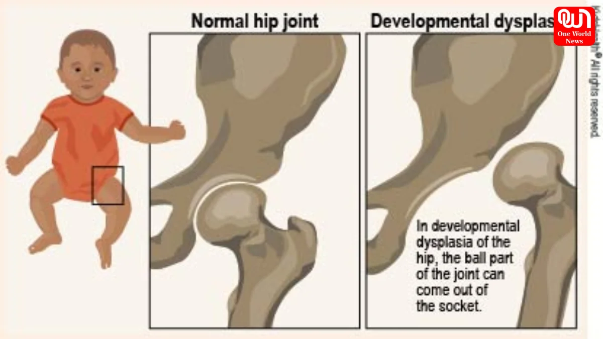 Developmental Dysplasia