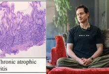 Autoimmune Gastritis Diagnosis