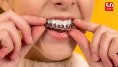 Aligners